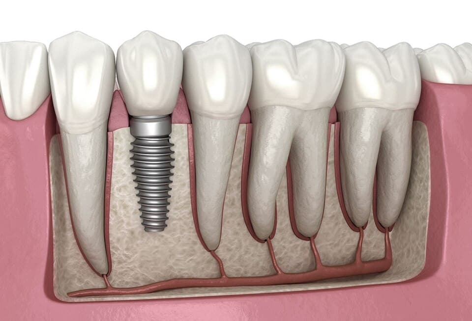 Pack implants BLT, lot de 20 unités